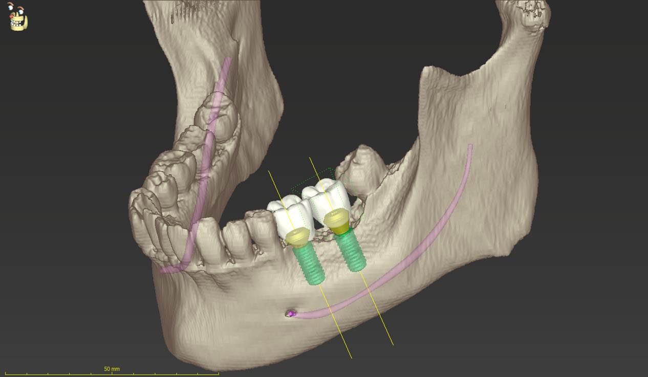 サージカルガイドを用いたインプラント治療のシミュレーション