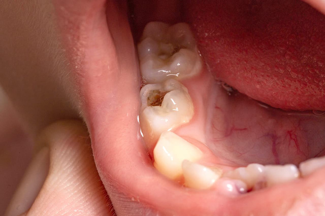 虫歯になっている歯