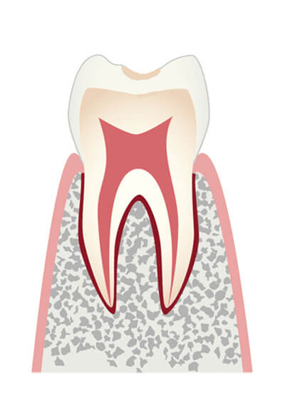 Co ごく初期のむし歯