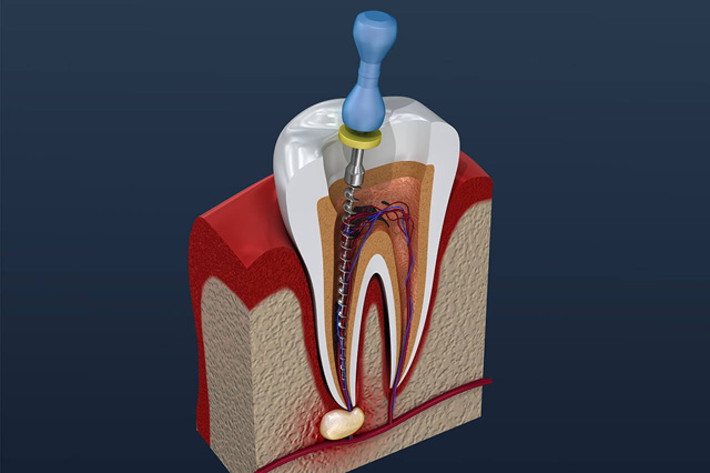 歯にドリルを入れているイラスト