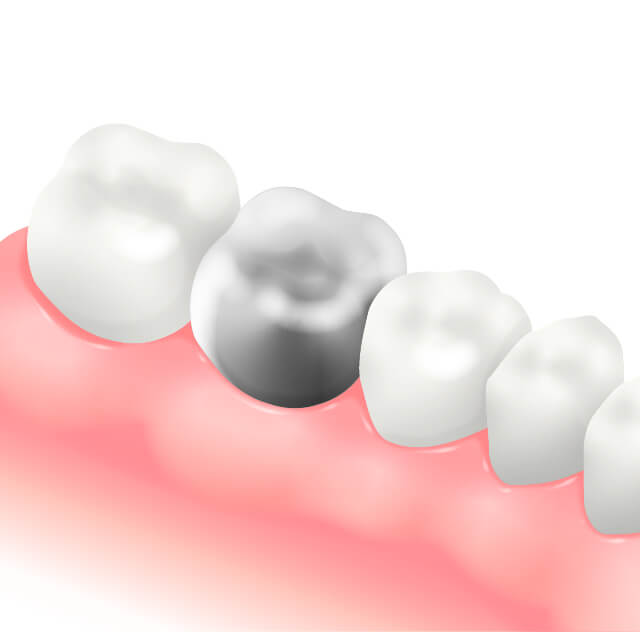 メタルクラウン(金属冠:銀歯)