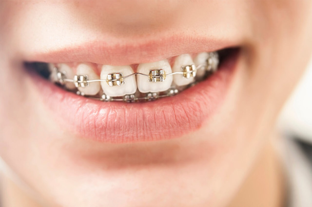 矯正中の歯を見せている女性