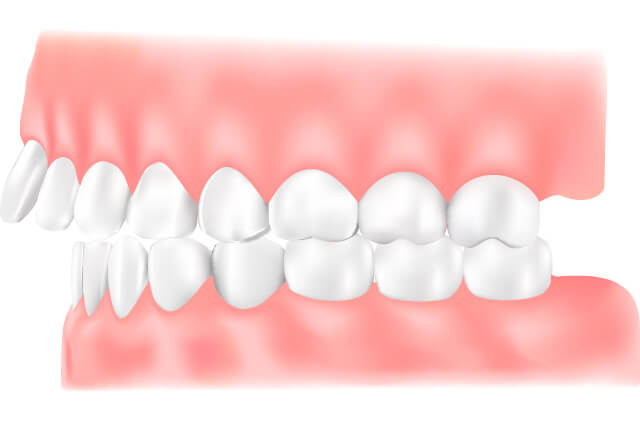 上顎前突(じょうがくぜんとつ)