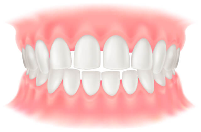 空隙歯列(くうげきしれつ)