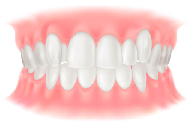 叢生(そうせい)