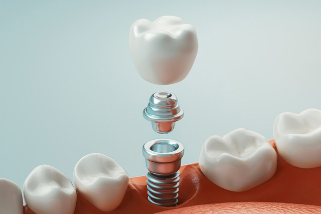 インプラントのイメージイラスト